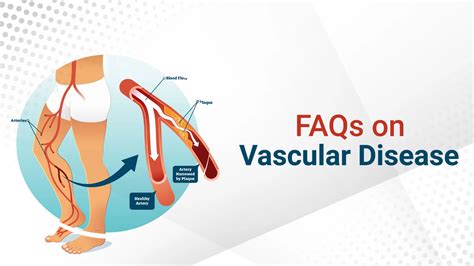 Vascular Diseases Cardiac Treatment