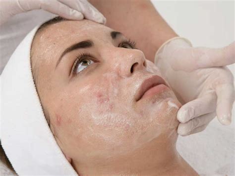 Chemical Face Peel Wellington Skin Pigmentation Treatment