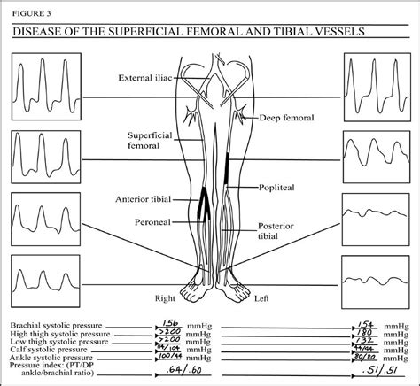 Lower Extremity Arterial Doppler Worksheet