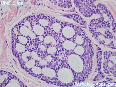 Adenoid Cystic Carcinoma Salivary Gland Histology