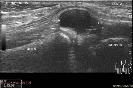 Ganglion Cyst Wrist Ultrasound