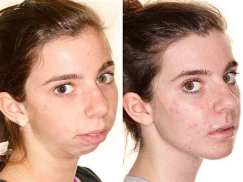 People Before And After Plastic Surgery 17 Pics