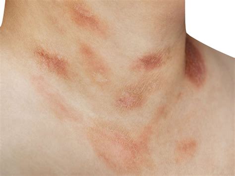 Pityriasis Rosea On Chest