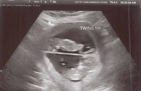 11 Weeks Pregnant With Twins Tips Advice And How To Prep Twiniversity