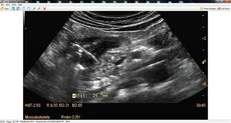 Vietnamese Medic Ultrasound Case 544 Gastric Perforation Due To