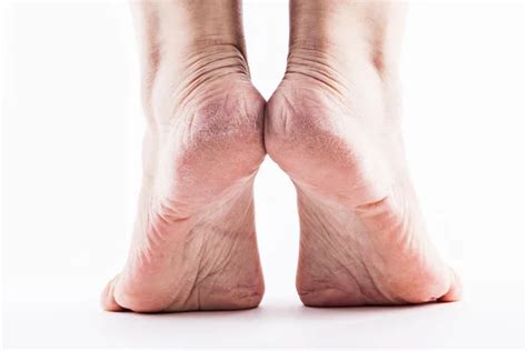 Sore Skin Of Feet Crack Dry Heels Clipping Path Stock Photo Download
