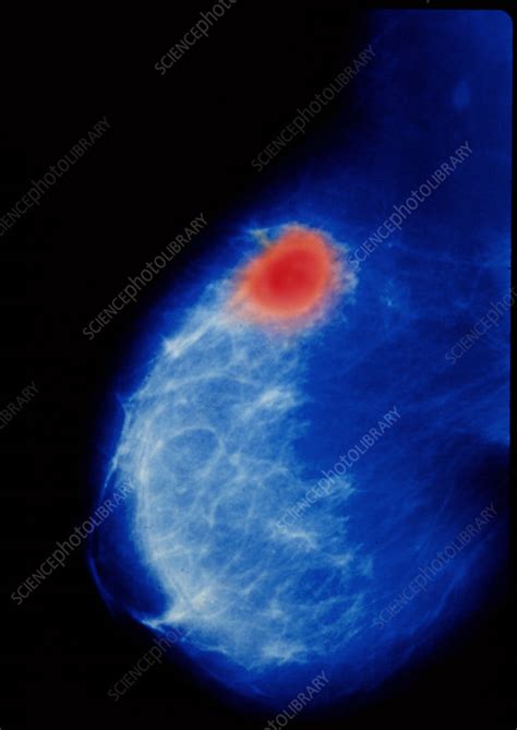 coloured mammogram x ray showing breast cancer stock image m122 0239 science photo library