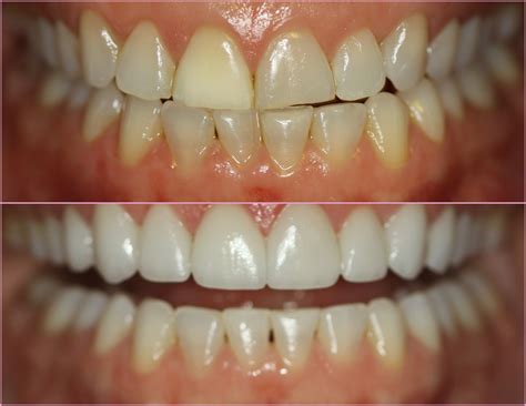 Porcelain Veneers Chicago ~ Before And After ~ July Case Of The Month
