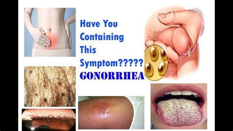Gonorrhea Symptoms Fasrmf