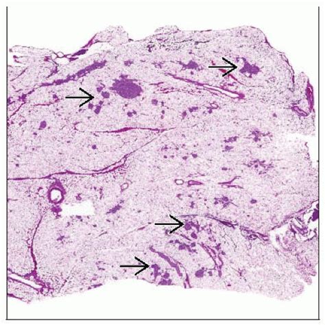 Cystic Fibrosis Pancreas Basicmedical Key