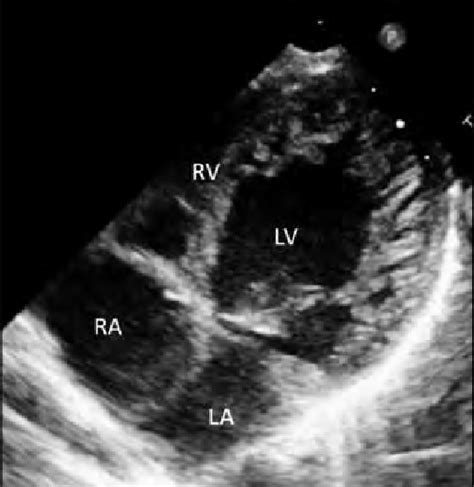 Transthoracic Echocardiography Of The Hypoplastic Right Ventricle And