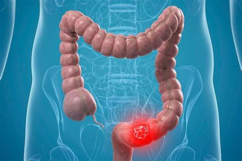 Tumore All Intestino Nel Cane Cause Sintomi E Cura Del Cancro