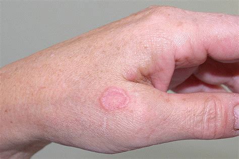 How Is Granuloma Annulare Diagnosed And Treated Daily Nutrition News