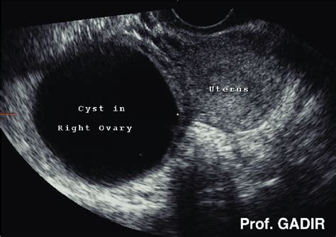 Functional Ovarian Cyst Ultrasound
