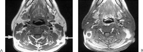 Metastatic Cervical Lymphadenopathy Radiology Key