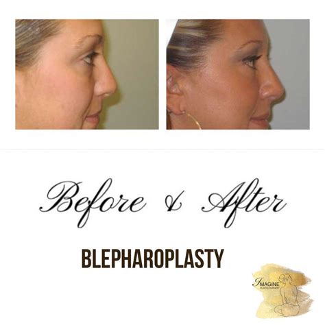 Blepharoplasty Before And After Eyelid Surgery Facial Procedure