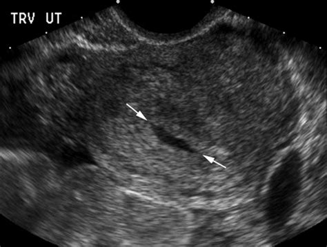 Intrauterine Fluid With Ectopic Pregnancy Benson 2013 Journal Of