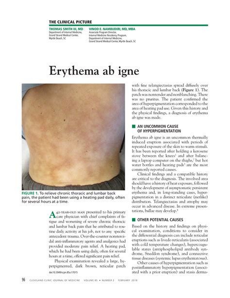 Erythema Ab Igne Cleveland Clinic Journal Of Medicine