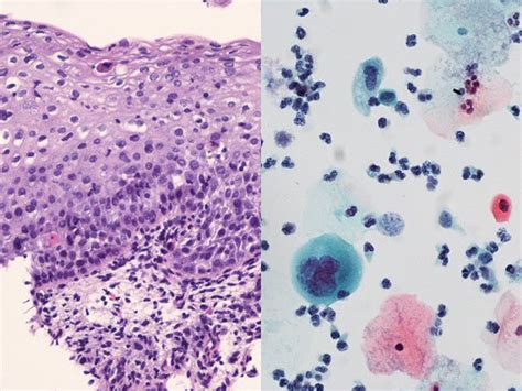 Invasive cancer means the cancer affects the deeper these lesions may go away on their own, but over time, they may become more abnormal. W A Center for Women's Gyn Health: Abnormal Pap Smear