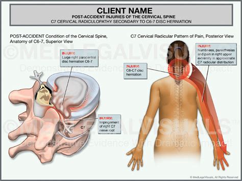 Cervical Radiculopathy After A Car Accident Premier Law Group