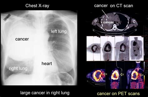chest x ray lung cancer