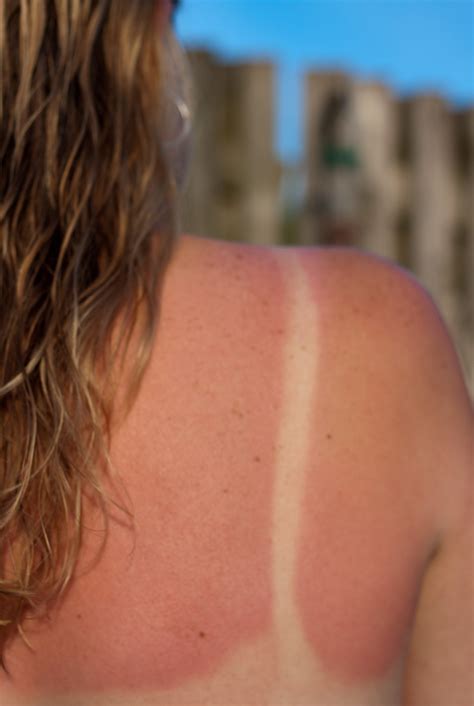 Learn how to prevent and treat sunburn. How to Treat a Sunburn - 5 Fast Sunburn Remedies That Work ...