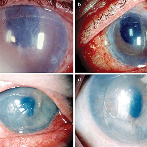 Pseudophakic Bullous Keratopathy With Anterior Chamber Lens B