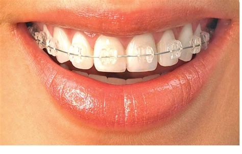 Which Should You Get Clear Braces Or Metal Braces