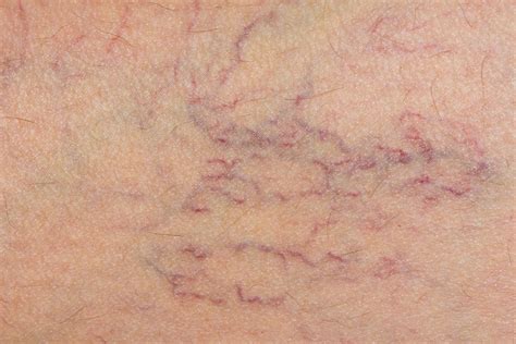 Varicose Veins And Spider Veins Causes And Treatment Live Science