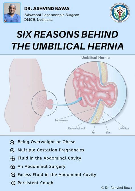 Pin On Hernia Awareness