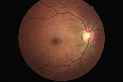 Brightfocus foundation funds research & educates the public about glaucoma. Glaucoma Imaging - Insight