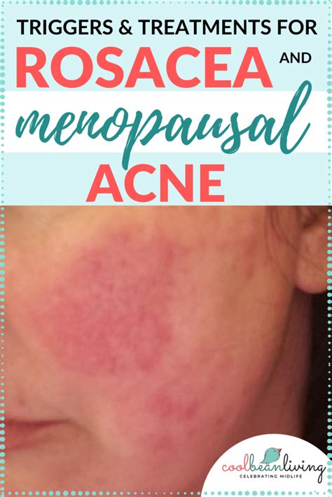 How To Treat Rosacea And Menopausal Acne Cool Bean Living