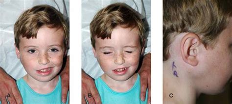 Pediatric Facial Nerve Palsy