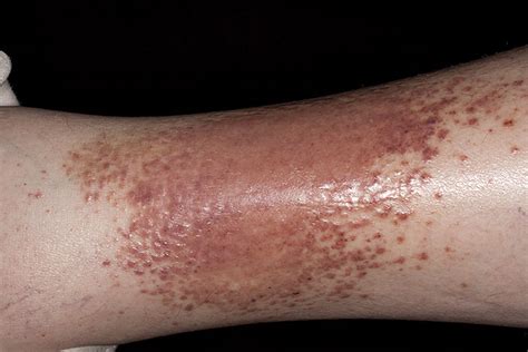Eczema On Leg Pictures Photos