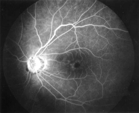 Latanoprost And Cystoid Macular Oedema In A Pseudophake British