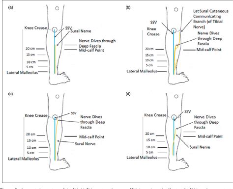 Figure 3 From The Sural Nerve Sonographic Anatomy Variability And