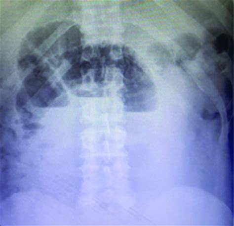 Abdominal X Rays Taken With The Patient Erect Show Multiple Air Fluid
