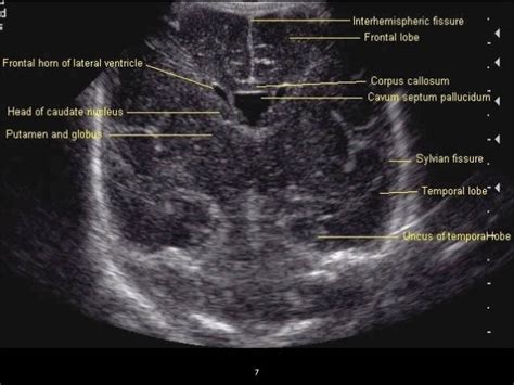 Neonatal Cranial And Spinal Ultrasound