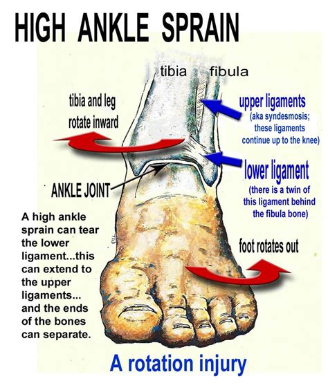 Ankle Sprain Energise Therapy