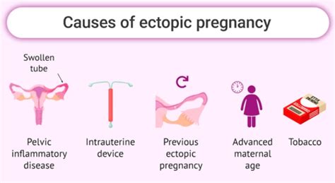 9 Week Ectopic Pregnancy Surgery Causes And Treatment