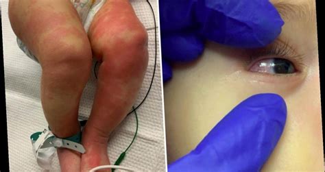 Some children have developed a rare but serious disease that is linked. Photos show first-known case of child suffering new ...