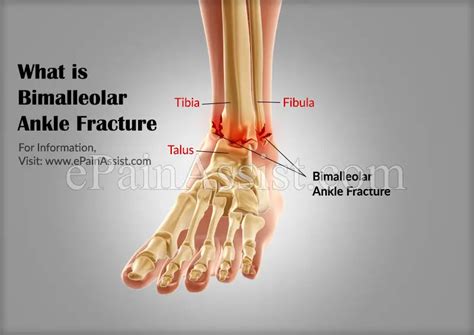 Displaced Trimalleolar Ankle Fracture
