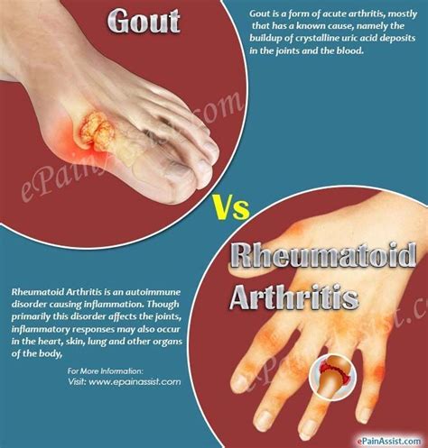 Gout Vs Rheumatoid Arthritis Rheumatoid Arthritis Gout Arthritis