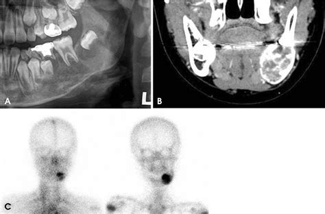Aneurysmal Bone Cyst Of The Mandible Managed By Conservative Surgical