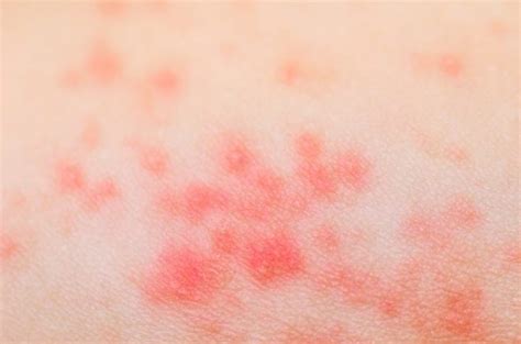 Rash Causes Types Symptoms And Other Associated Risk Factors