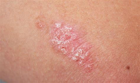 Skin Cancer Symptoms Itchy Red Patch Could Be A Sign Of Condition