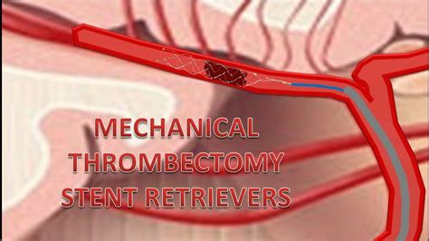 Video 40 Mechanical Thrombectomy Stent Retrievers Youtube