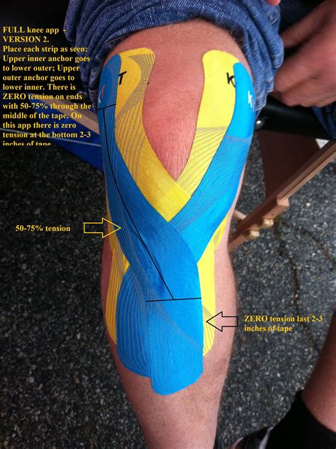 Kt Tape For Outer Knee Pain Dimplewolhok