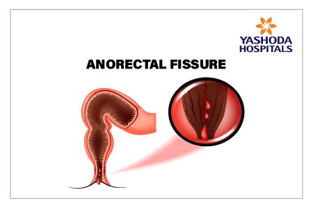 Anal Fissure Causes Symptoms Diagnosis And Treatment
