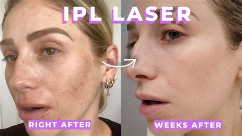 Ipl Clear And Brilliant Laser Review What Are They Are They